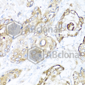 Immunohistochemistry of paraffin-embedded human prostate cancer using NRG4 antibody at dilution of 1:100 (40x lens).