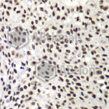 Immunohistochemistry of paraffin-embedded human lung cancer using NELFE antibody at dilution of 1:100 (x40 lens).