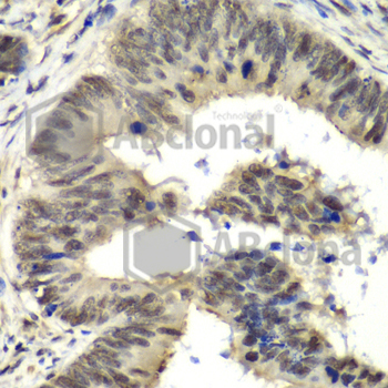 Immunohistochemistry of paraffin-embedded human colon carcinoma using NELFE antibody at dilution of 1:100 (x40 lens).