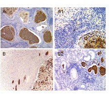 Immunhistochemical analysis of ASC2/POP1 expression in mouse using ab47092 at 1:2000. A, prostate tissue from a male mouse prostatitis. B, kidney from a mouse with pyelonephritis. A1 and B1, high magnification of A and B, respectively. ASC2/POP1 staining is seen in the granulocytes
