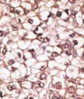 Formalin-fixed, paraffin-embedded human hepatocarcinoma tissue reacted with ab71792 at a 1:50 dilution, which was peroxidase-conjugated to the secondary antibody, followed by AEC staining.