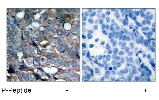 ab47304 staining human breast carcinoma tissue by IHC-P (left hand panel). The right hand panel shows staining in the presence of phospho-peptide.