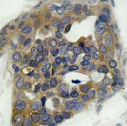 ab39402, at a 1/100 dilution, staining human ASK1 in breast carcinoma tissue by Immunohistochemistry, Paraffin embedded tissue.