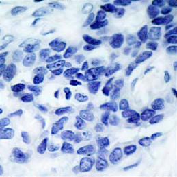 ab39402, at a 1/100 dilution, staining human ASK1 in breast carcinoma tissue (treated with synthesized phosphopeptide) by Immunohistochemistry, Paraffin embedded tissue.