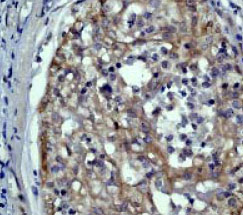 ab40850 at a 1:50 dilution staining Asparagine synthetase in human breast carcinoma tissue.