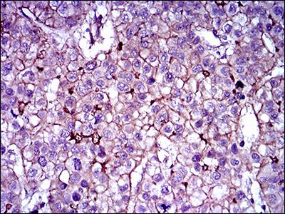 Immunohistochemical analysis of paraffin-embedded Human liver cancer tissue labeling ABCB5 with ab140667 at 1/200 dilution followed by DAB staining.