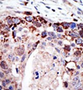 Formalin fixed and paraffin embedded human breast carcinoma tissue stained with ab38863, followed by AEC staining. ab38863 at 1/50 dilution.