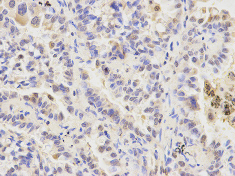 Immunohistochemistry (Formalin/PFA-fixed paraffin-embedded sections) analysis of human lung cancer tissue labelling ATG4A with ab187508 at 1/200. Magnification: 400x.