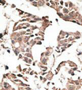 Immunohistochemistry analysis of formalin-fixed and paraffin-embedded Human cancer tissue, labeling ATG4C with ab173796 at 1/50 dilution. Peroxidase-conjugaion to the secondary antibody, followed by AEC staining.