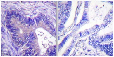 Ab59297 at 1/50 dilution staining human colon carcinoma without (left) and with (right) immunizing peptide; paraffin embedded.