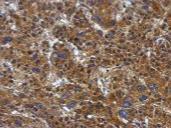 ab126129, at 1/500 dilution, staining ATP citrate lyase in paraffin embedded Human hepatoma tissue by Immunohistochemistry.