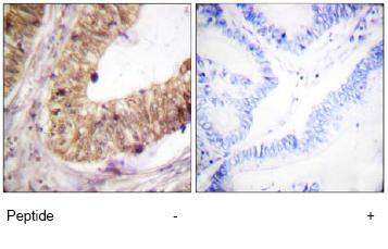 ab59346, at a 1/50 dilution, staining human ATRIP in lung carcinoma, using Immunohistochemistry, Paraffin embedded tissue, in the absence (left image) and presence of the immunizing peptide (right image).