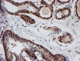 ab128529, at 1/150 dilution, staining ATRIP in paraffin-embedded Human breast tissue by Immunohistochemistry.