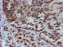 ab128529, at 1/150 dilution, staining ATRIP in paraffin-embedded Human ovary adenocarcinoma tissue by Immunohistochemistry.