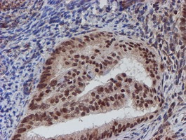 ab128529, at 1/150 dilution, staining ATRIP in paraffin-embedded Human endometrium adenocarcinoma tissue by Immunohistochemistry.