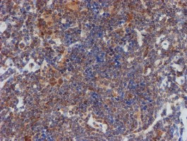 ab128529, at 1/150 dilution, staining ATRIP in paraffin-embedded Human lymphoma tissue tissue by Immunohistochemistry.