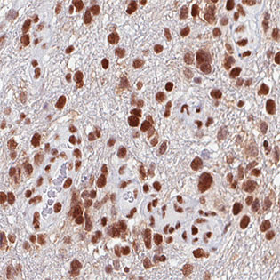 Immunohistochemical analysis of formalin-fixed, paraffin-embedded Human brain (high grade glioma) tissue, labeling ATRX with ab188027 at 1/200 dilution.