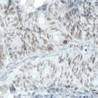 Immunohistochemical analysis of formalin-fixed, paraffin-embedded Human colorectal cancer tissue, labeling ATRX with ab188027 at 1/200 dilution.
