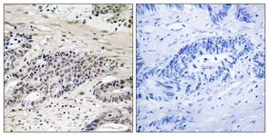 Immunohistochemistry analysis of paraffin-embedded human colon carcinoma, using 1/50 ab111410. The picture on the right is treated with the phopspho peptide.