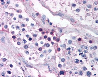 ab118634 at 1/50 dilution staining Aurora A (phospho T288) in Formalin-Fixed, Paraffin-Embedded Human Testis tissue by Immunohistochemistryfollowed by biotinylated secondary antibody, alkaline phosphatase-streptavidin and chromogen.