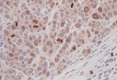 Rabbit polyclonal to Aurora B (ab2254) used to stain SW620 human tumour xenografts (in mouse).The sections were microwave pretreated in citrate buffer (pH 6.0) for 5 mins high then 5 mins simmer (800W conventional microwave). Slides were then incubated for 1 hour with the Aurora B primary antibody diluted 1/200 in TBS, then visualised using DAB, after application of an appropriate secondary.