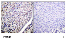 ab62702 at 1/50 - 1/100 dilution staining Aurora B in human liver carcinoma by Immunohistochemistry, Paraffin-embedded tissue, in the absence or presence of the immunising peptide.