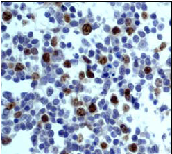Ab45145 staining human Aurora B in human Hodgkin lymphoma by immunohistochemistry using paraffin embedded tissue.