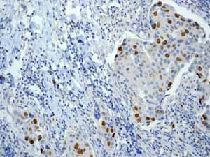 ab45145 showing positive staining in Breast carcinoma tissue.