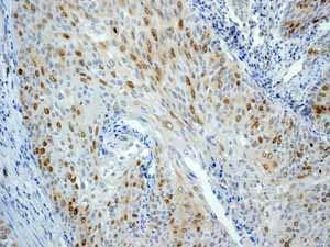ab45145 showing positive staining in Cervical carcinoma tissue.