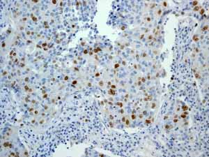 ab45145 showing positive staining in Lung adenocarcinoma tissue.