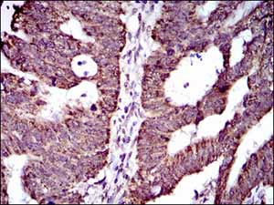 Immunohistochemical analysis of paraffin-embedded rectum cancer tissues labeling ABCG5 with ab175421 at 1/200 dilution with DAB staining.