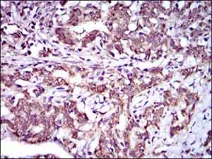 Immunohistochemical analysis of paraffin-embedded cervical cancer tissues labeling ABCG5 ith ab175421 at 1/200 dilution with DAB staining,