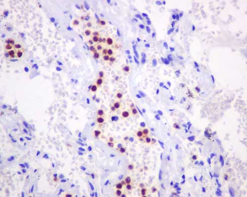 Immunohistochemical analysis of paraffin-embedded Human lung tissue labeling Azurocidin with ab181989 at a 1/100 dilution. Prediluted (ready to use) HRP Polymer for Rabbit IgG was used as a secondary antibody. Counter stain: Hematoxylin