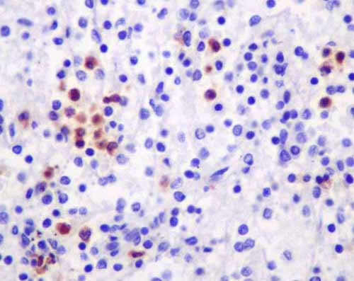 Immunohistochemical analysis of paraffin-embedded Human spleen tissue labeling Azurocidin with ab181989 at a 1/100 dilution. Prediluted (ready to use) HRP Polymer for Rabbit IgG was used as a secondary antibody. Counter stain: Hematoxylin