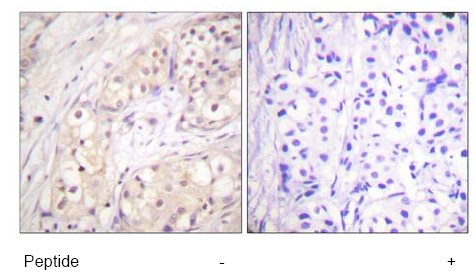 ab59354, at a 1/500-1/100 dilution, staining human B Raf in breast carcinoma with (+) or without (-) immunising peptide, using Immunohistochemistry, Paraffin embedded tissue