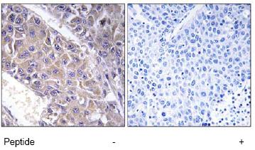 ab74825, at a dilution of 1/50, staining B4GALT3 in paraffin embedded human liver carcinoma tissue sections by Immunohistochemistry in the absence (left image) or presence (right image) of the immunizing peptide.