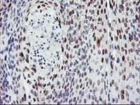 ab128486 at 1/150 dilution staining BACH1.3 in paraffin-embedded Human bladder carcinoma tissue by immunohistochemistry.