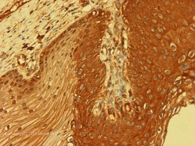 IHC image of Ab86298 staining in Humna Cervical Carcinoma formalin fixed paraffin embedded tissue section, performed on a Leica BondTM system using the standard protocol F. The section was pre-treated using heat mediated antigen retrieval with sodium citrate buffer (pH6, epitope retrieval solution 1) for 20 mins. The section was then incubated with Ab86298, 1µg/ml, for 15 mins at room temperature and detected using an HRP conjugated compact polymer system. DAB was used as the chromogen. The section was then counterstained with haematoxylin and mounted with DPX. For other IHC staining systems (automated and non-automated) customers should optimize variable parameters such as antigen retrieval conditions, primary antibody concentration and antibody incubation times.