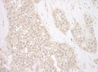 Immunohistochemical analysis of formalin-fixed, paraffin-embedded Human breast carcinoma tissue labeling Bag3 with ab193463 at 1/200 dilution with DAB staining.