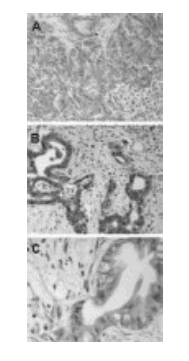 Immunohistochemistry of formalin fixed paraffin embedded human pancreas tissue sections using ab47124 at 1/2000. A, normal pancreas. B and C, pancreatic cancer. Hematoxylin-eosin counterstain.