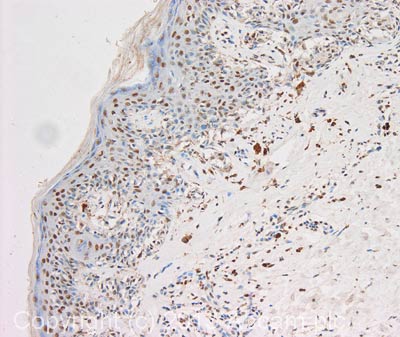 IHC image of BCL7C staining in human skin melanoma formalin fixed paraffin embedded tissue section, performed on a Leica Bond system using the standard protocol F. The section was pre-treated using heat mediated antigen retrieval with sodium citrate buffer (pH6, epitope retrieval solution 1) for 20 mins. The section was then incubated with ab56514, 5µg/ml, for 15 mins at room temperature and detected using an HRP conjugated compact polymer system. DAB was used as the chromogen. The section was then counterstained with haematoxylin and mounted with DPX.For other IHC staining systems (automated and non-automated) customers should optimize variable parameters such as antigen retrieval conditions, primary antibody concentration and antibody incubation times.