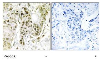 ab129777, at 1/50 dilution, staining BCOR in paraffin-embedded Human breast carcinoma tissue by immunohistochemistry in the presence (right panel) or absence (left panel) of immunizing peptide.
