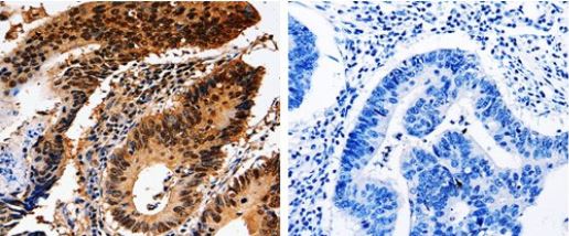 Immunohistochemical analysis of paraffin-embedded Human colon cancer tissue lableing 14-3-3 epsilon with ab182656 at 1/10 dilution (left panel). Right panel is treated with the immunogen.