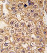 Immunohistochemical analysis of formalin-fixed, paraffin-embedded Human hepatocarcinoma tissue labelling beta 2 Adrenergic Receptor with ab135641 at 1/10 dilution, followed by a peroxidase conjugated secondary antibody and DAB staining.