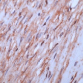 ab16039 at 1/100 dilution staining Human beta Actin in Leiomyoma by Immunohistochemistry (FFPE-sections) 