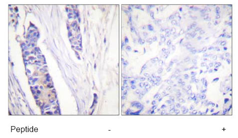 1/50 ab58446 staining beta tubulin in paraffin-embedded human breast carcinoma tissue by Immunohistochemistry, with and without blocking peptide. 
