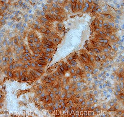 IHC image of beta Tubulin staining in human liver carcinoma FFPE section, performed on a Leica BondTM system using the standard protocol F. The section was pre-treated using heat mediated antigen retrieval with sodium citrate buffer (pH6, epitope retrieval solution 1) for 20 mins. The section was then incubated with ab6046, 5µg/ml, for 15 mins at room temperature and detected using an HRP conjugated compact polymer system. DAB was used as the chromogen. The section was then counterstained with haematoxylin and mounted with DPX.