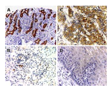 Formalin-fixed, paraffin-embedded sections of tumor and normal human tissues stained for BAR expression using Ab47127 at 1/2000. A. Pancreatic cancer. B. Normal pancreas. C. Esophageal cancer. D. Normal esophagus. Increased expression of BAR was detected in the tumor, compared to normal tissues. Hematoxylin-eosin counterstain."