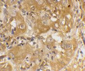 ab7888 at 20µg/ml staining Bim in human cancer cells by IHC-P