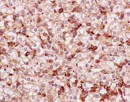Immunohistochemical analysis of paraffin embedded Human clear cell carcinoma of kidney tissue labeling BIN1 with ab182562 at 1/100.
